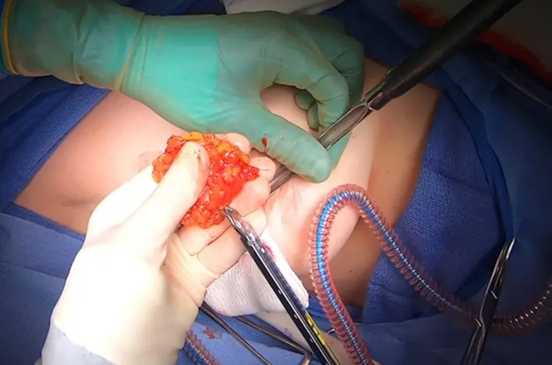 Sentinel Node Biopsy