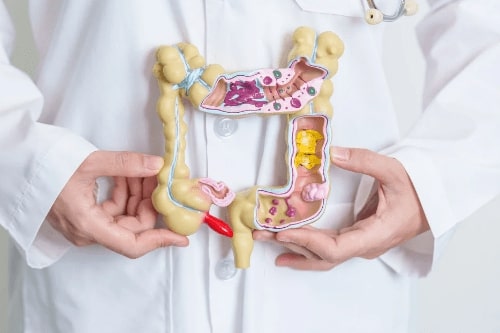 Colorectal cancer care