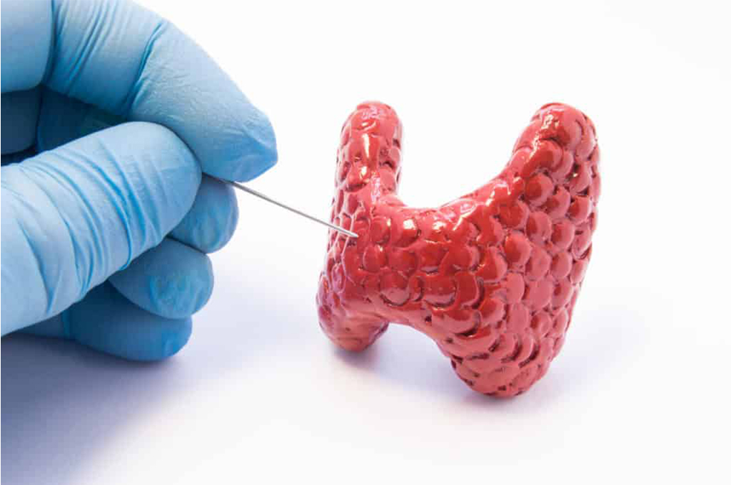 Thyroid Cancer