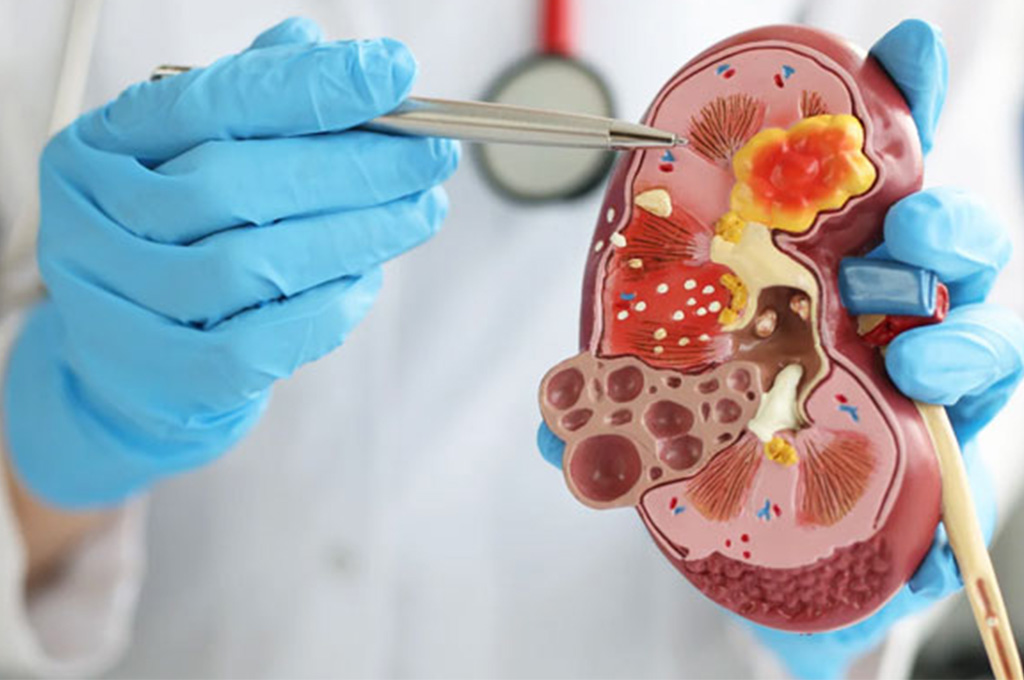 Urological Cancer
